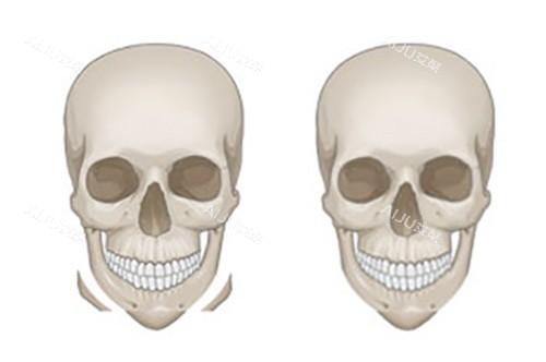 张笑天下颌削骨示意图