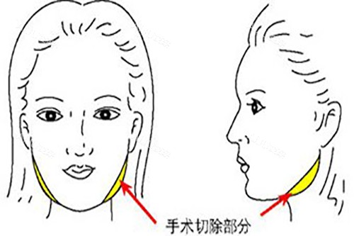 张笑天方脸削骨示意图1