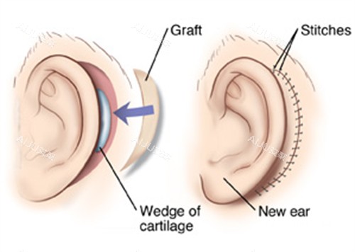 耳再造手术的切口