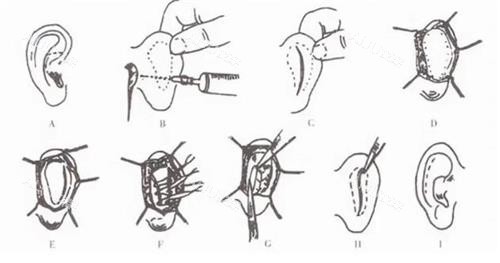 耳朵矫正手术