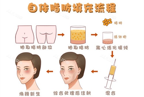 自体脂肪填充过多了怎么消除？一文查看有效消除自体脂肪的五大方法