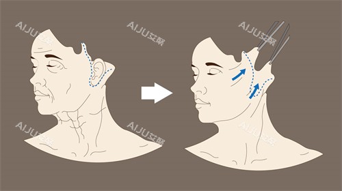 埋线提升和拉皮提升哪个好？从创伤性/改善时间/维持时间/适应症进行对比