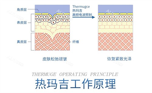 在线查看埋线提升和热玛吉的区别：在成效/适应人群/维持时间/可靠性等方面都有差异