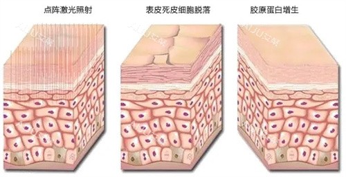 点阵激光过程