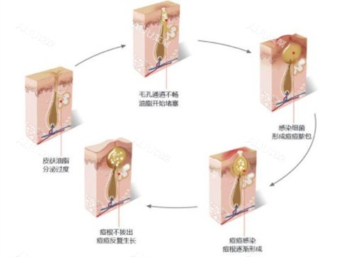 痘坑怎么生成的