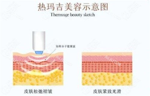 热玛吉美容示意图