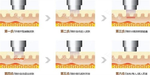 黄金微针多久做一次成效好？修复能力强的话可以1-2月进行下次治疗