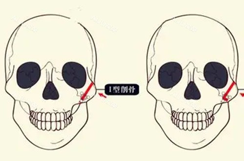 磨骨可以维持一辈子吗？揭秘磨骨手术原理、维持时间、截骨及术后护理