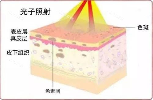 光子嫩肤做一次能维持多久？可以维持三个月到半年左右，具体看皮肤代谢情况