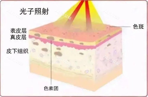 光子嫩肤原理卡通示意图