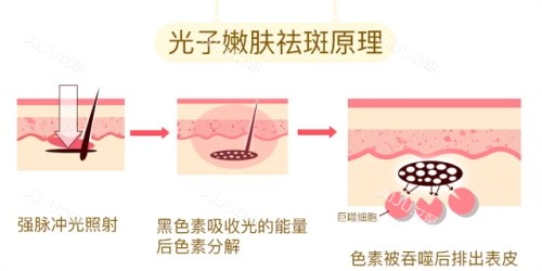 在线查看飞顿光子嫩肤的功效和作用、价格！飞顿光子嫩肤做一次大概在3000元起