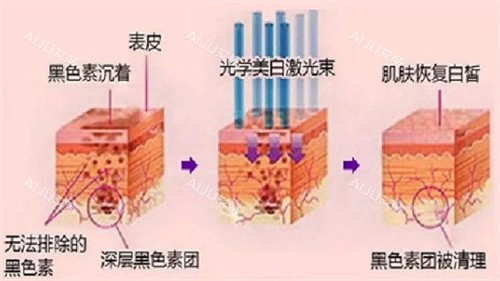 光子嫩肤原理