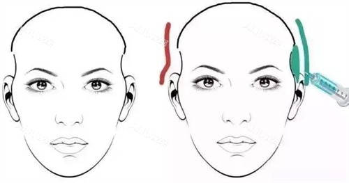 太阳穴凹陷玻尿酸注射对比动画图