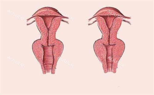 女性阴道松弛和紧致对比