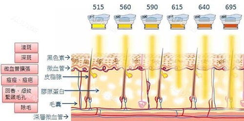 光子嫩肤原理图