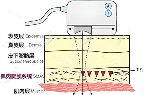 热拉提作用皮肤层