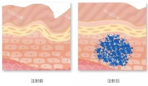 稀洛因注射前后示意图