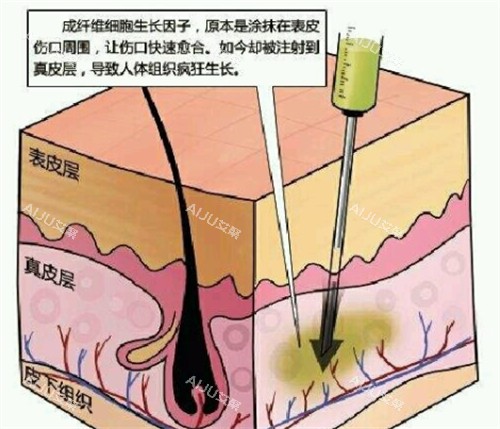 生长因子的副作用解析