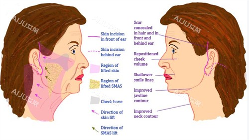 面部提升手术对比图