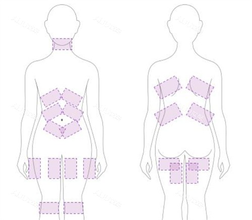 美国既塑3D溶脂可施术部位
