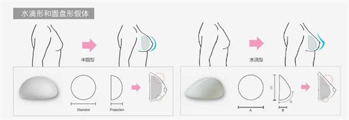 隆胸手术过程