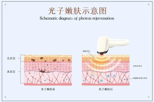 光子嫩肤的示意图