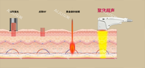 尖峰超声王作用皮肤层次透视图