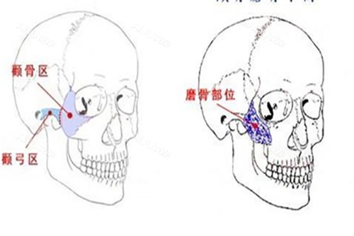 颧骨磨骨手术示意图