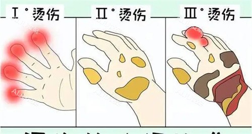 烧烫伤等级动画图