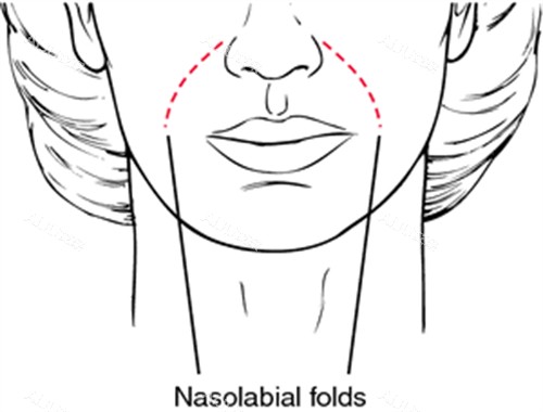 鼻基底凹陷导致法令纹