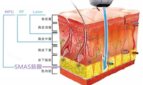 激光作用原理