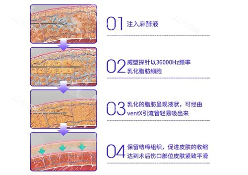 威塑吸脂手术步骤演示动画图