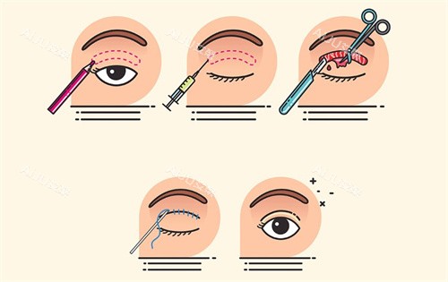 埋线双眼皮过程卡通图