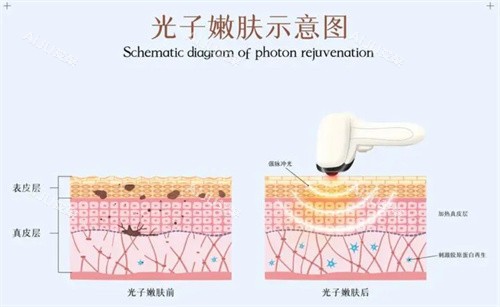 光子嫩肤