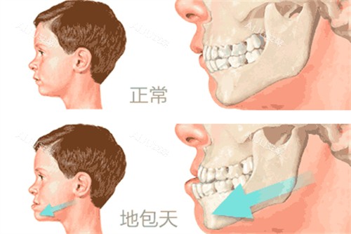 兜下巴与正常咬合对比动画图