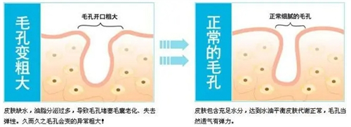 正常毛孔和粗大毛孔