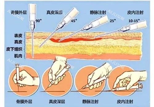 爱贝芙注射示意图