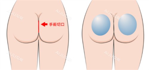 假体丰臀手术切口