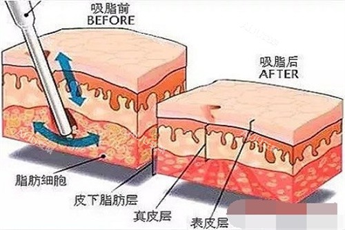 吸脂前后脂肪对比图