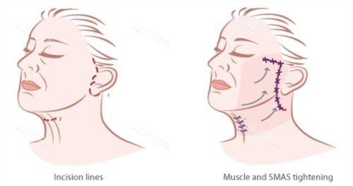 SMAS面部提升手术的对比和切口