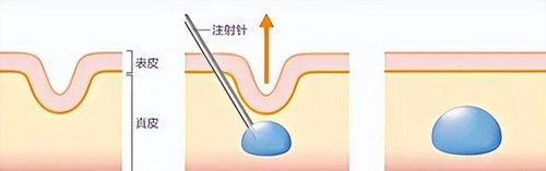 菲林普利针