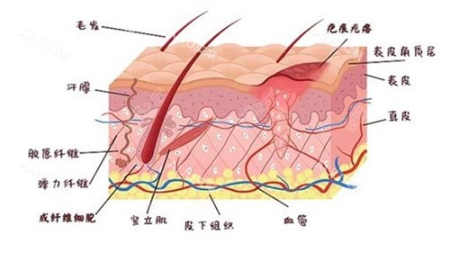 疤痕增生原理