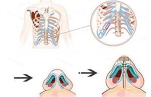 肋骨鼻手术过程