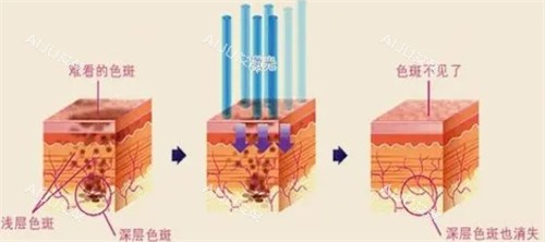 魔颜之光激光祛斑前后对比