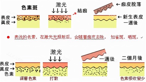 魔颜之光激光祛斑过程