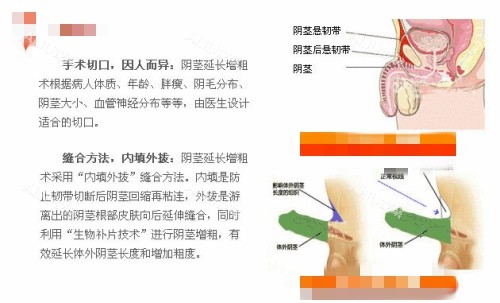 生物补片增粗手术介绍示意图