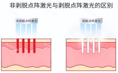 非剥脱点阵激光和剥脱点阵激光