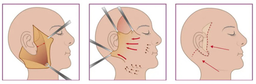 拉皮手术过程