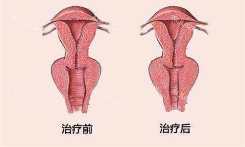 徒手私护私密治疗对比图