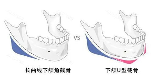 下颌角截骨位置示意图